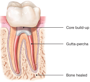 Healed-Tooth-Following-Root-Canal.jpg